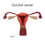 Скрининг на выявление рака шейки матки